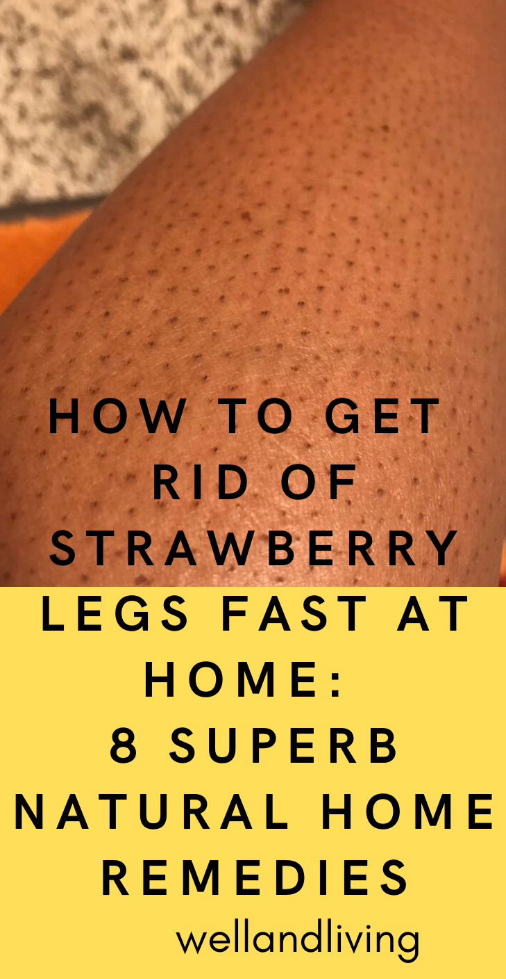 How to Get Rid Of Strawberry Legs Fast At Home: 8 Superb Natural Home ...
